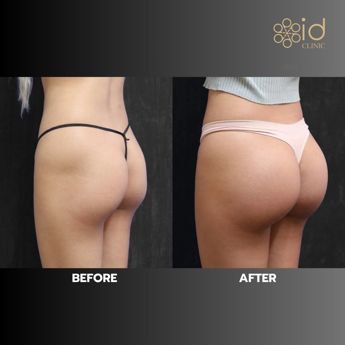 Avant et après implants fessiers à ID Clinic Bangkok, résultat contour amélioré