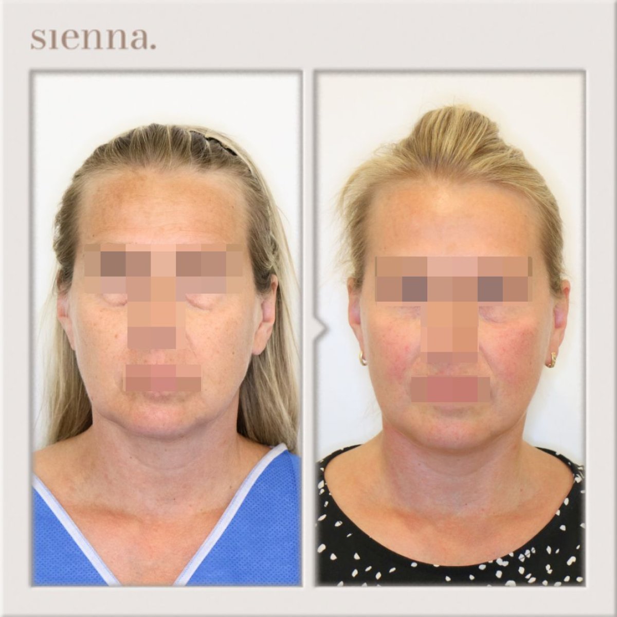 before and after photo