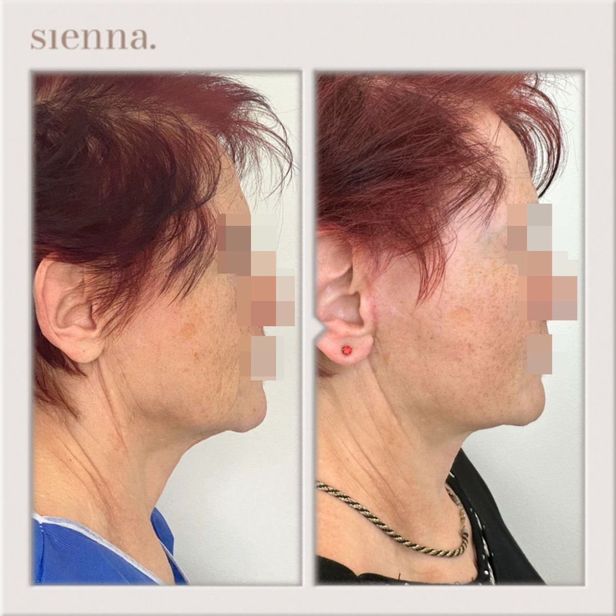 before and after photo