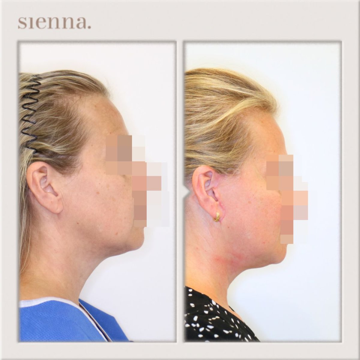 before and after photo