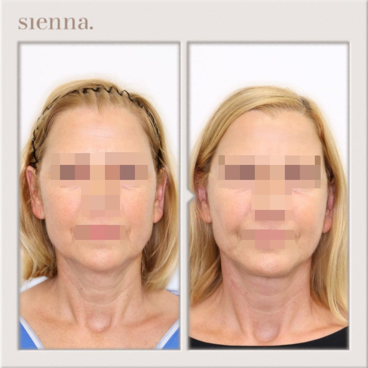 before and after photo