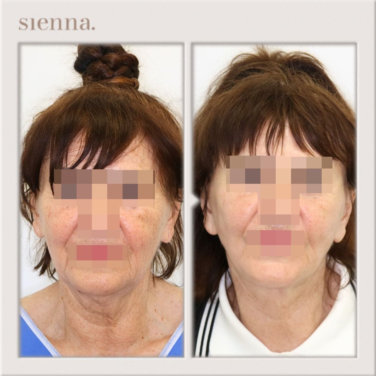 before and after photo