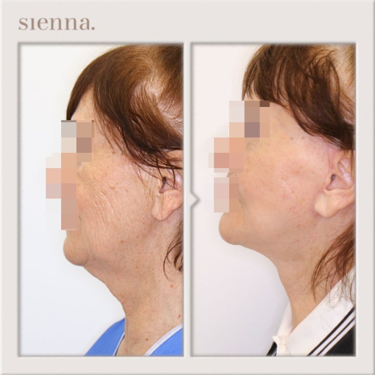 before and after photo