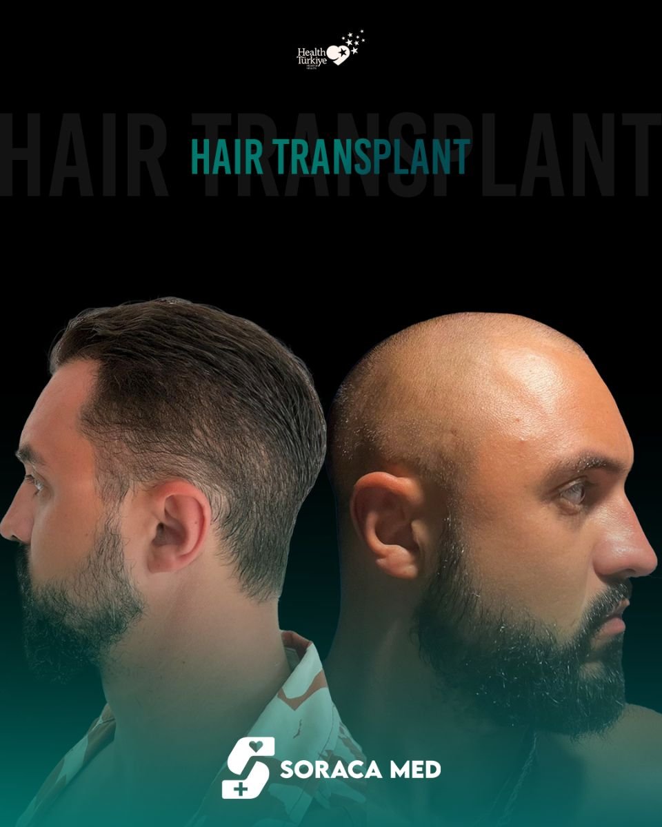 Résultats avant et après greffe de cheveux FUE chez Soraca Med – ligne capillaire restaurée