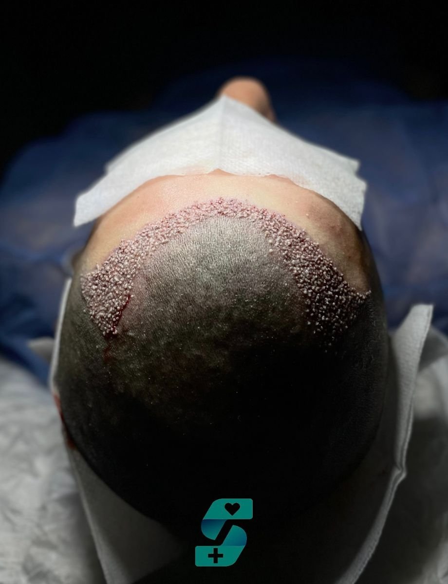 Resultado de trasplante capilar FUE en Soraca Med: injertos implantados para restaurar la línea