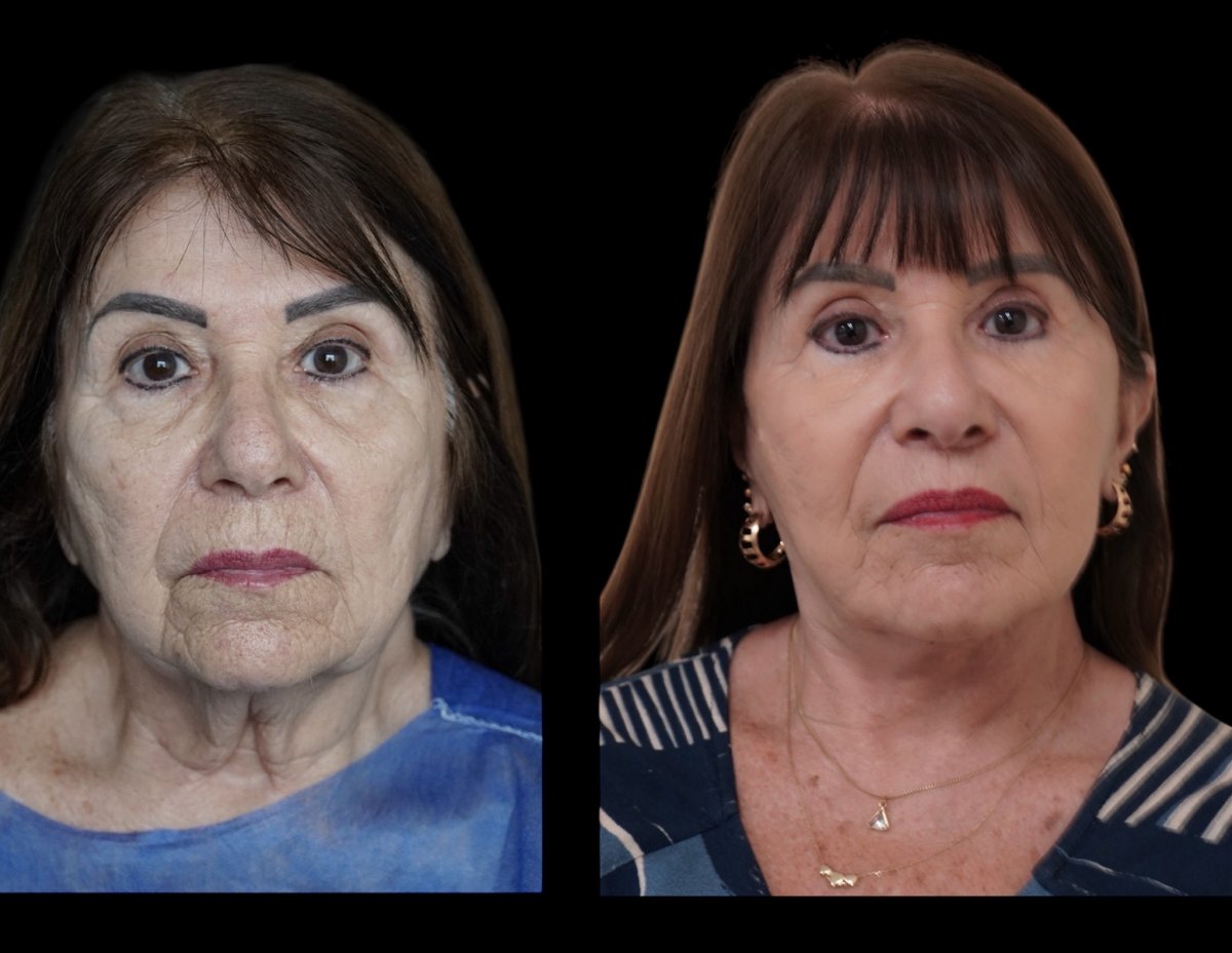 before and after photo