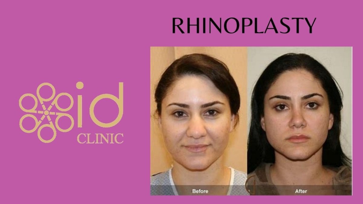 Resultados antes y después de rinoplastia étnica en ID Clinic Bangkok, mejora de la nariz
