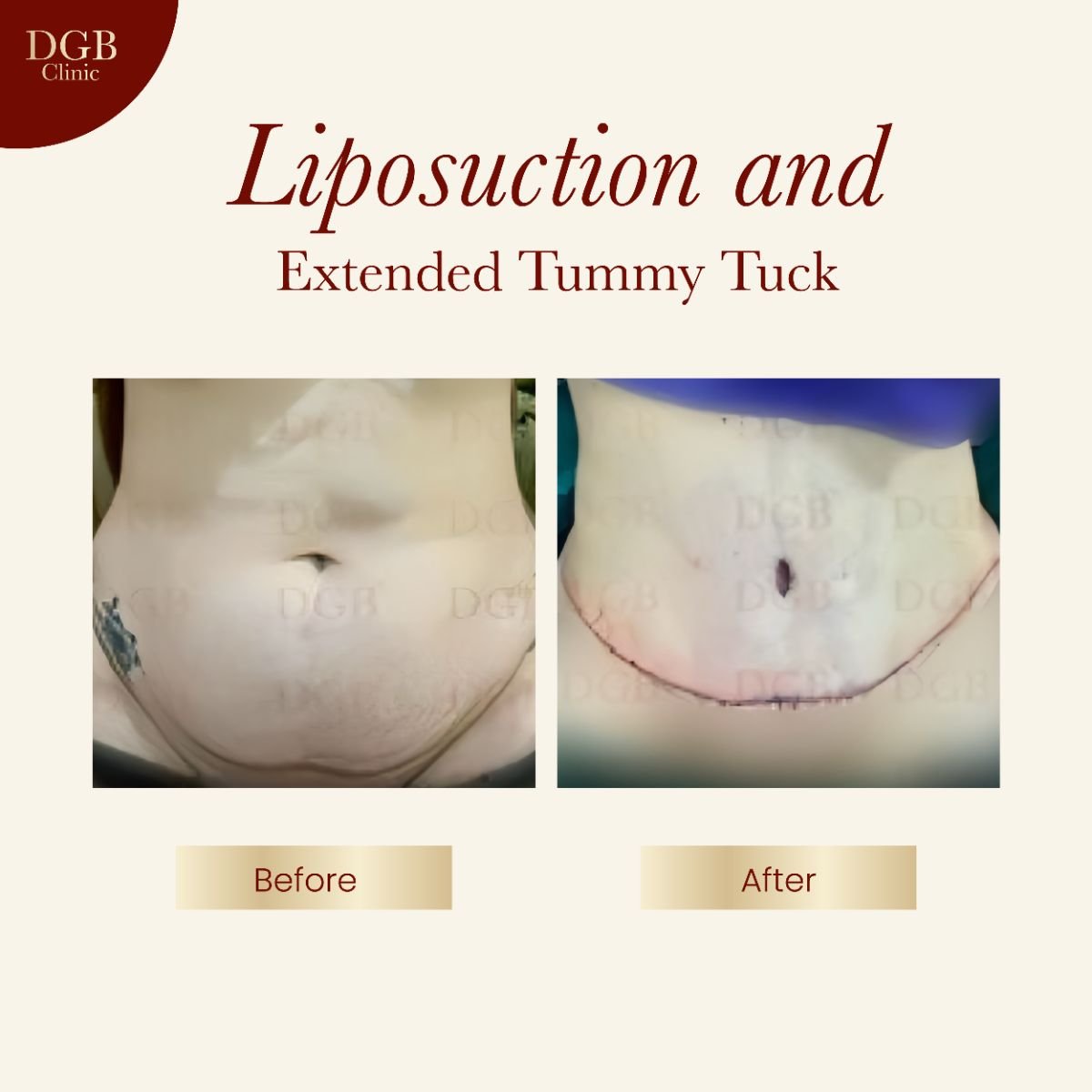 Resultados antes y después de liposucción y abdominoplastia extendida en DGB Clinic, abdomen plano