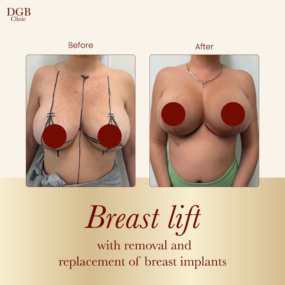 Antes y después de lifting de senos con recambio de implantes en DGB Clinic, resultado visible