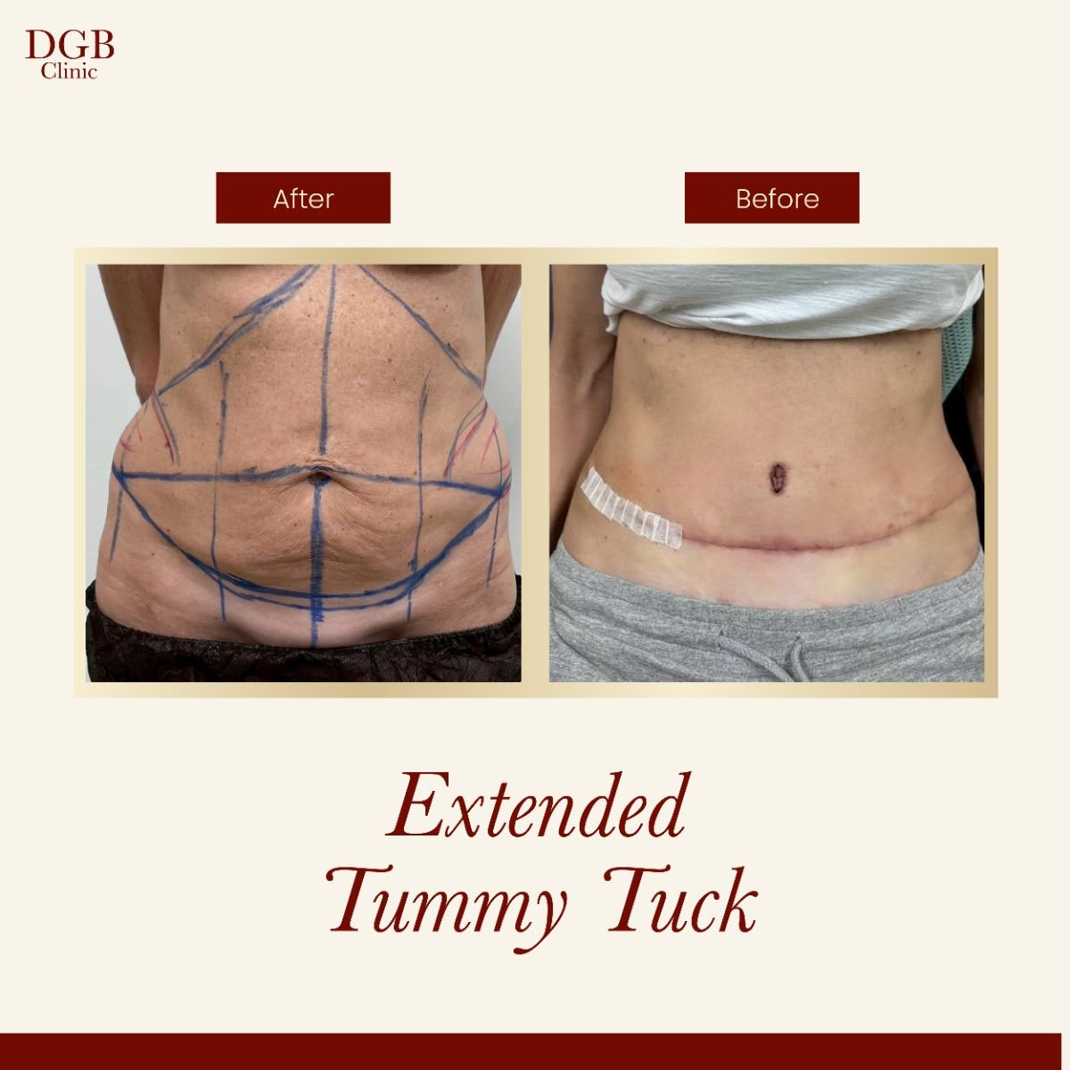 Resultados antes y después de abdominoplastia extendida en DGB Clinic, contorno abdominal visible