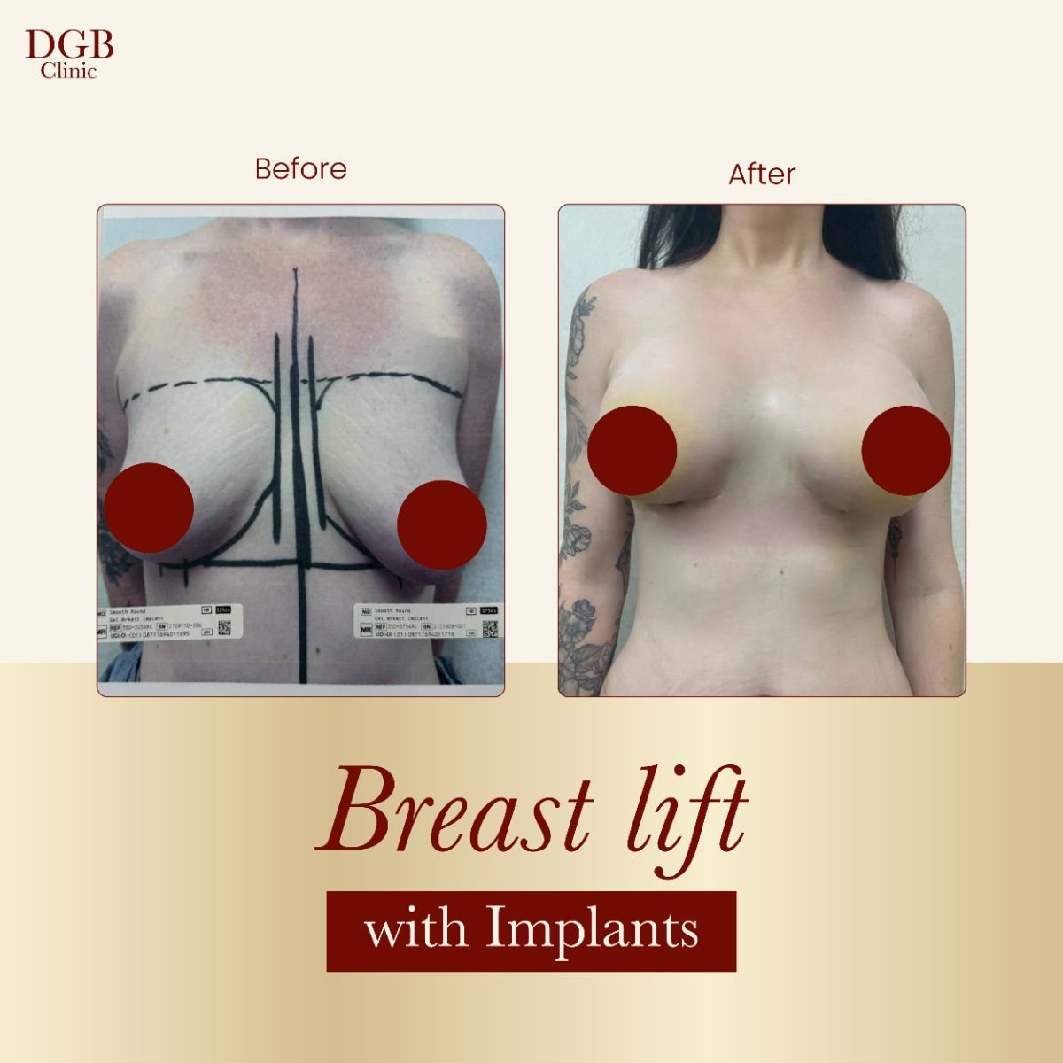 Antes y después de elevación de senos con implantes en DGB Clinic, mejora visible del contorno