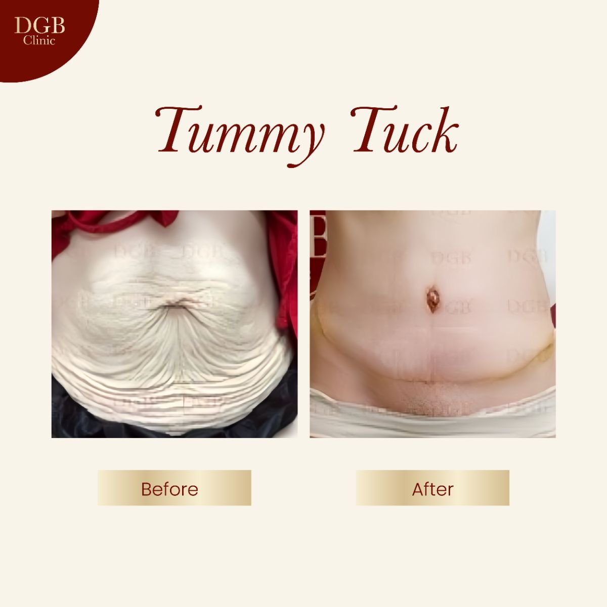 Before and after tummy tuck results at DGB Clinic – visible abdominal contour improvement