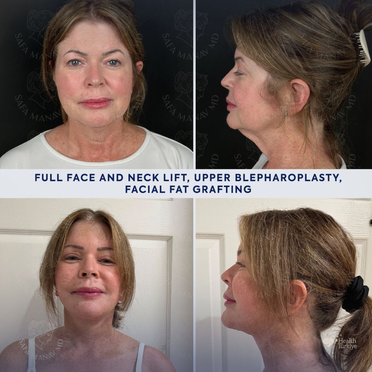 Résultats avant et après transfert de graisse faciale à la clinique Dr. Safa Manav