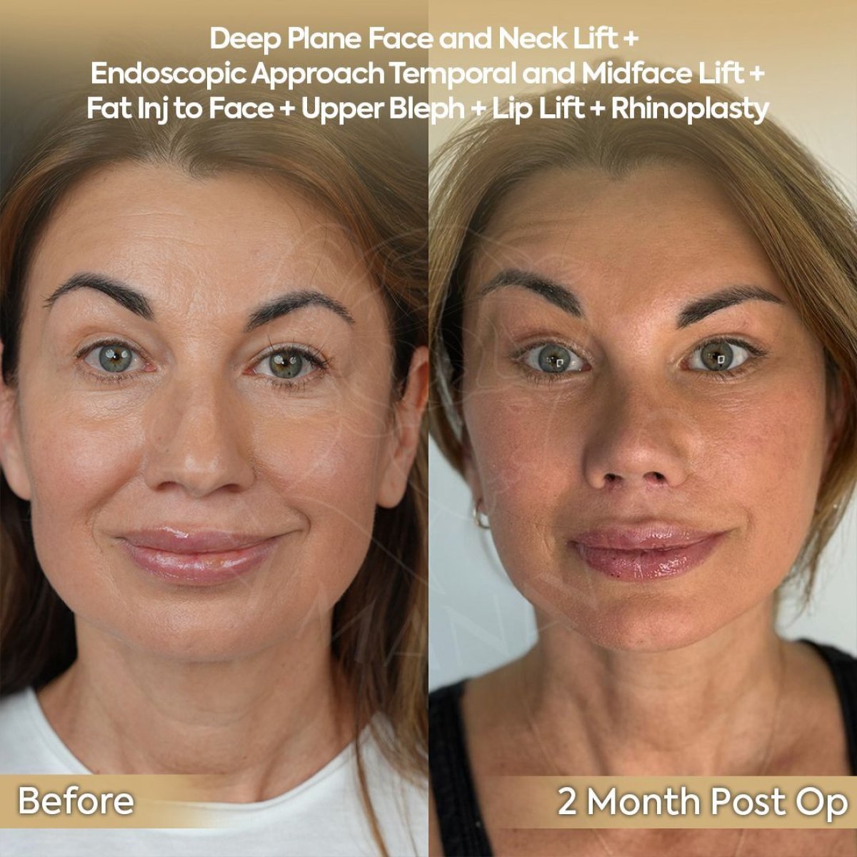 Résultats avant/après lipofilling visage à la clinique Dr. Safa Manav, rajeunissement visible