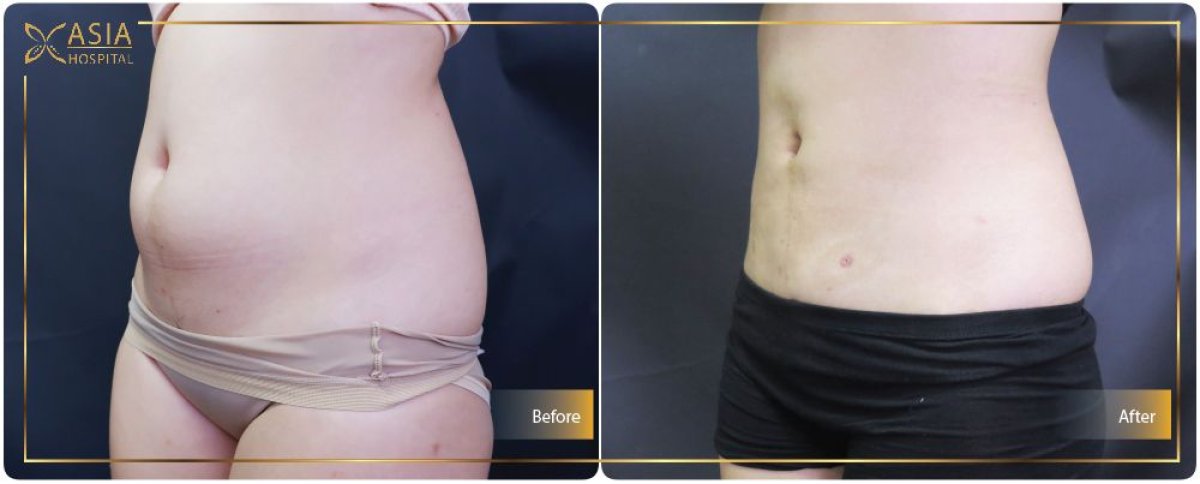 نتائج نحت البطن قبل وبعد في Asia Cosmetic Hospital، عضلات بطن محددة