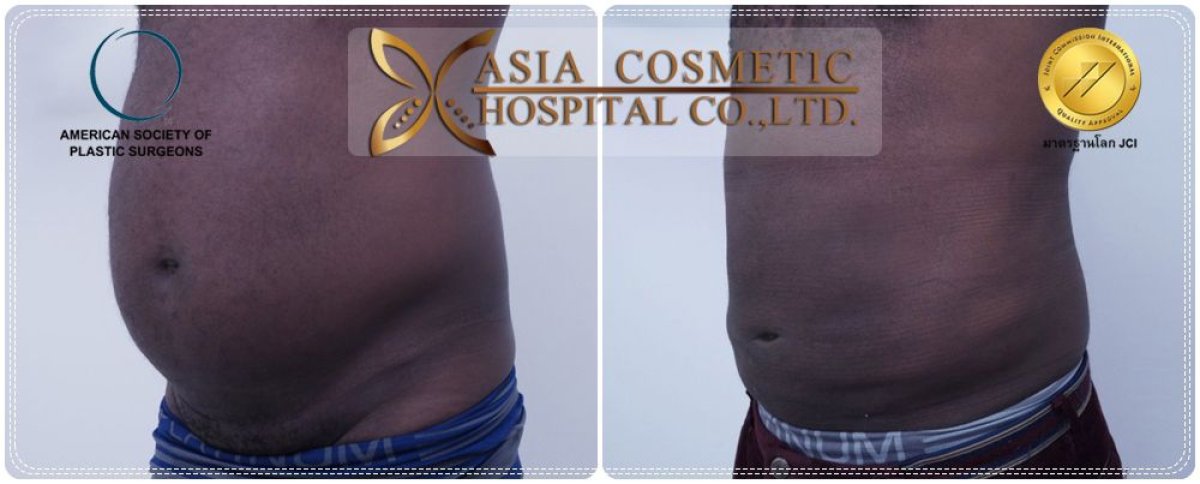قبل وبعد نحت البطن في Asia Cosmetic Hospital، نتيجة عضلات البطن الستة واضحة