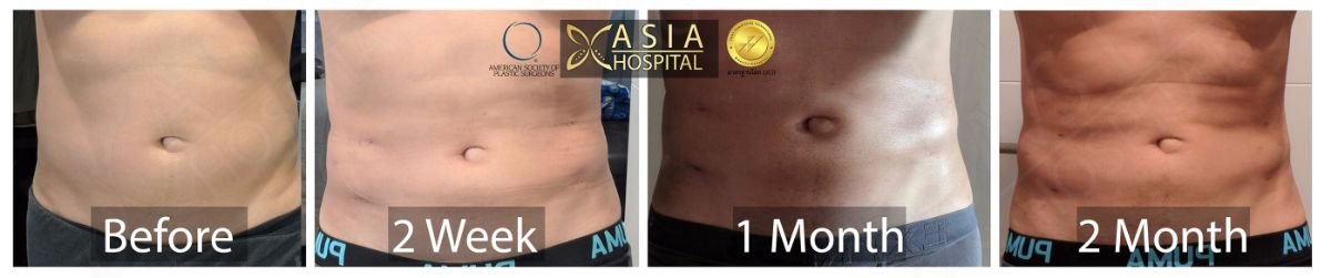 Resultados de abdominal etching en Asia Cosmetic Hospital, progreso visible de abdominales
