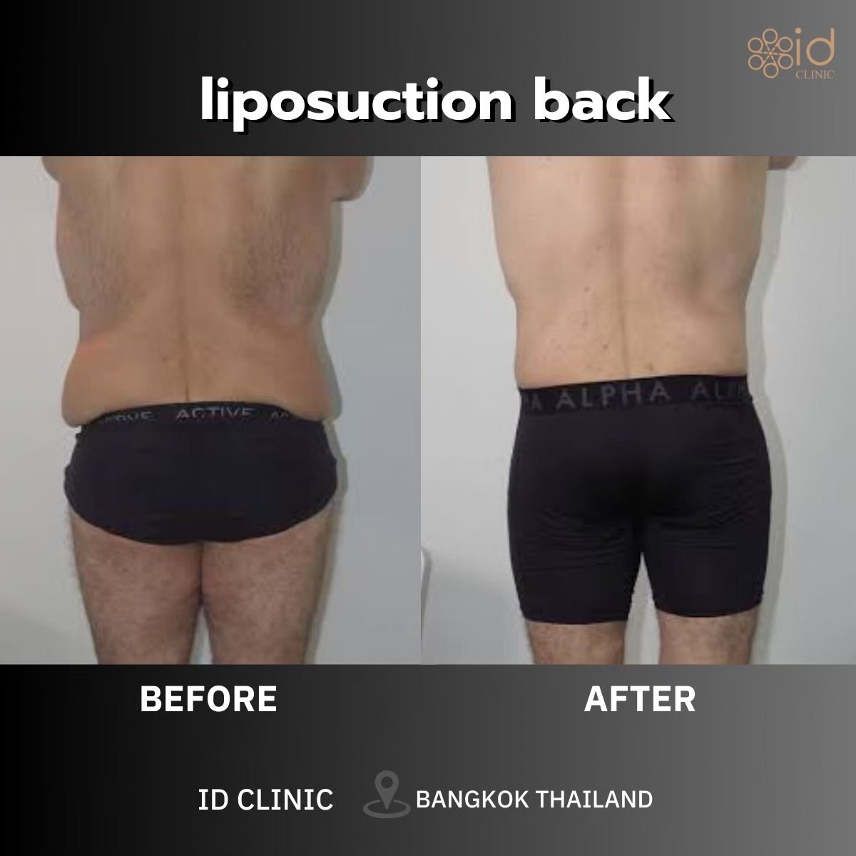 نتائج شفط دهون الظهر Vaser قبل وبعد في ID Clinic Bangkok، تقليل واضح للدهون