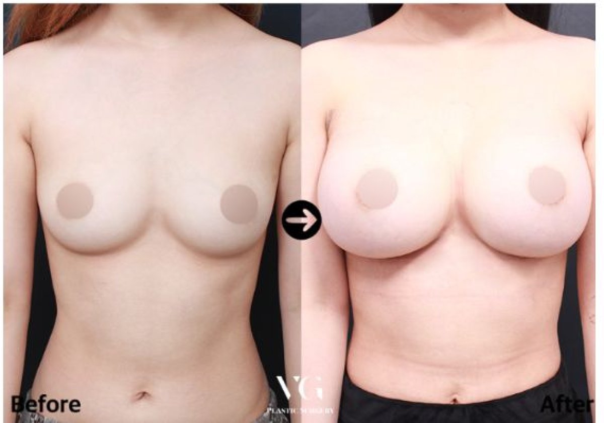 Resultados antes y después de aumento de senos en VG Plastic Surgery – mayor volumen mamario