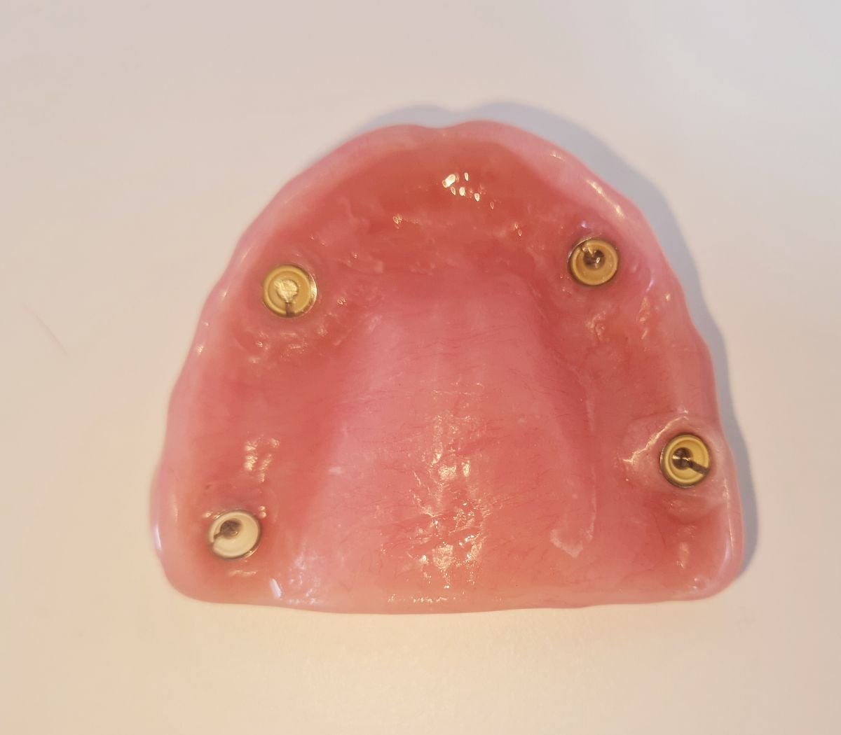 نتيجة طقم أسنان مدعوم بالزرعات في SoftDentalCare Clinic، طقم فك علوي