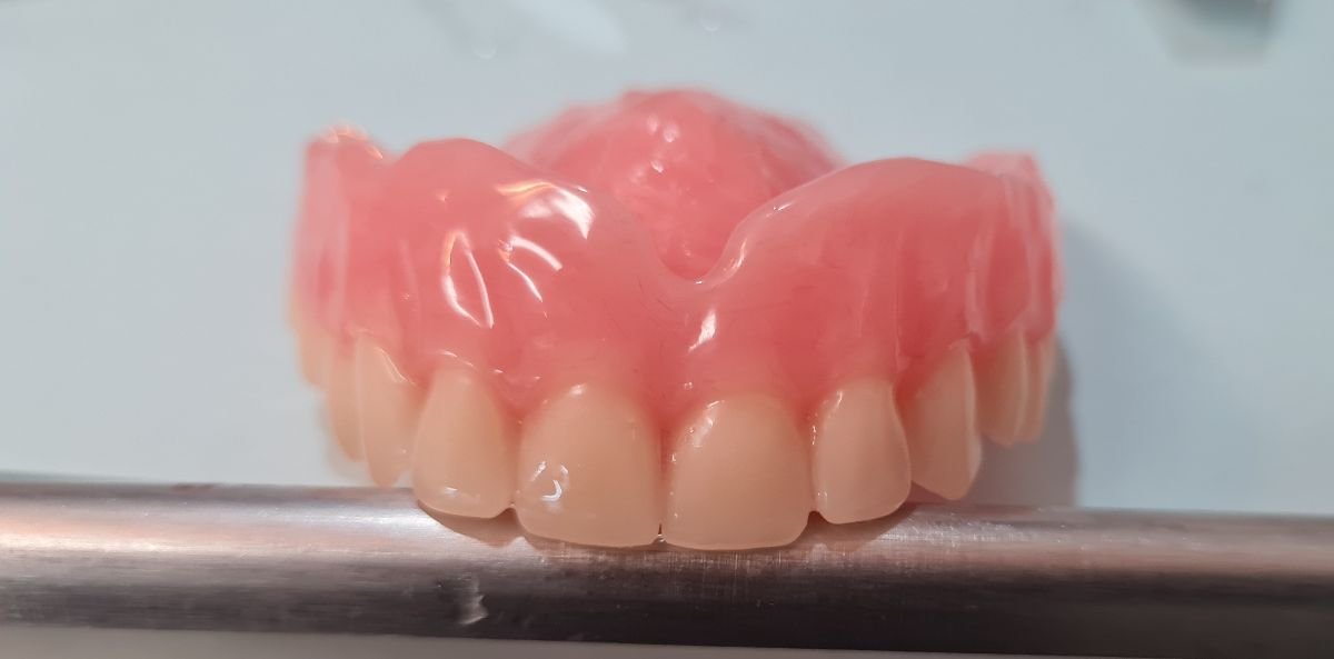 Upper denture result at SoftDentalCare Clinic, natural-looking artificial teeth restoration