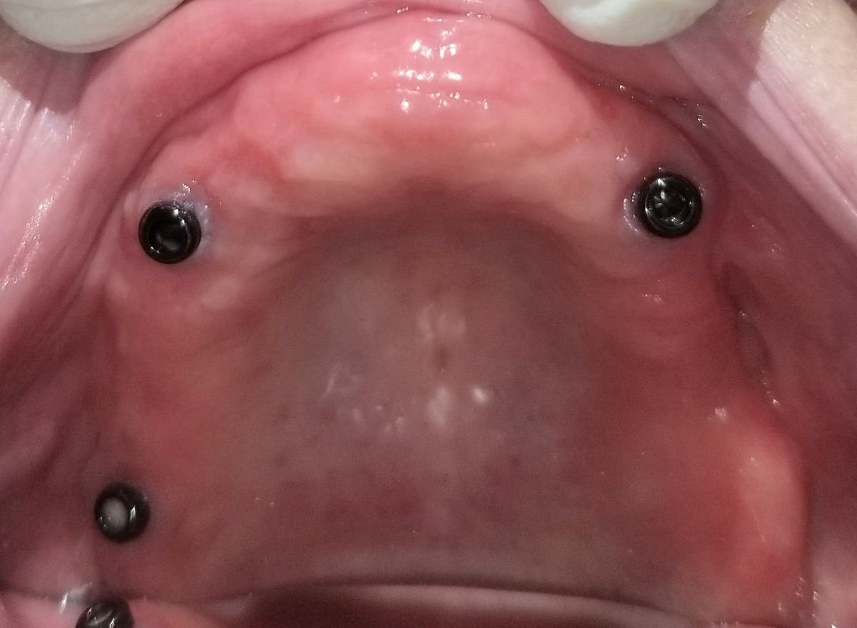 Implants dentaires maxillaires pour prothèse chez SoftDentalCare Clinic, résultat du traitement