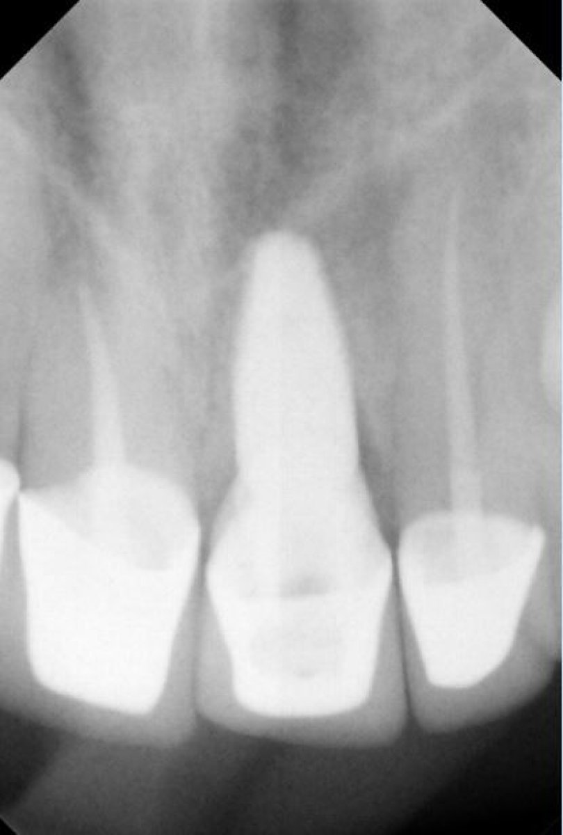نتيجة أشعة سينية لزراعة الأسنان في SoftDentalCare Clinic تظهر ترميم السن بنجاح