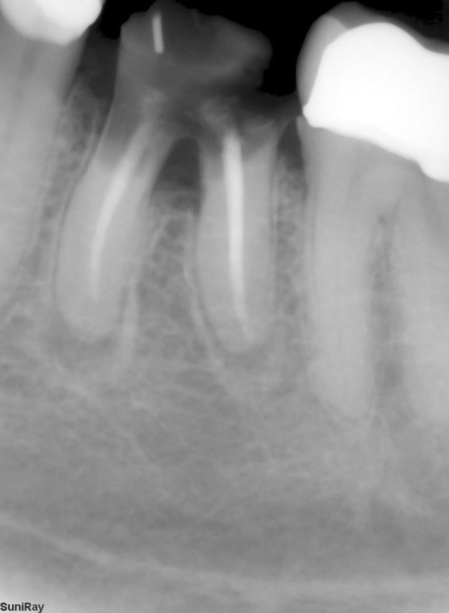 نتيجة أشعة زرع الأسنان في SoftDentalCare Clinic تظهر بنية السن المستعادة