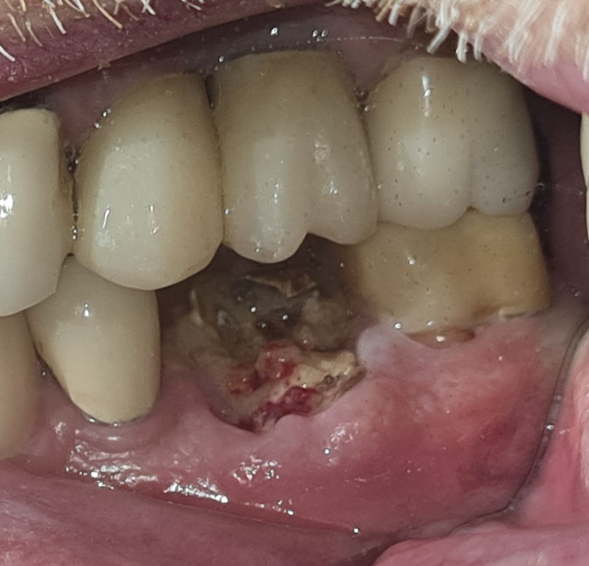 الفك السفلي قبل زراعة الأسنان في SoftDentalCare Clinic، منطقة السن المفقود واضحة