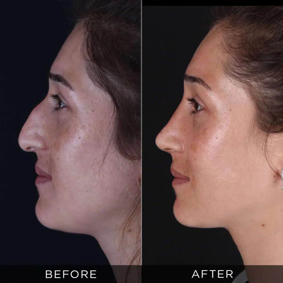 نتائج عملية تجميل الأنف قبل وبعد في عيادة Dr. Hasan Duygulu Private Practice، إعادة تشكيل الأنف