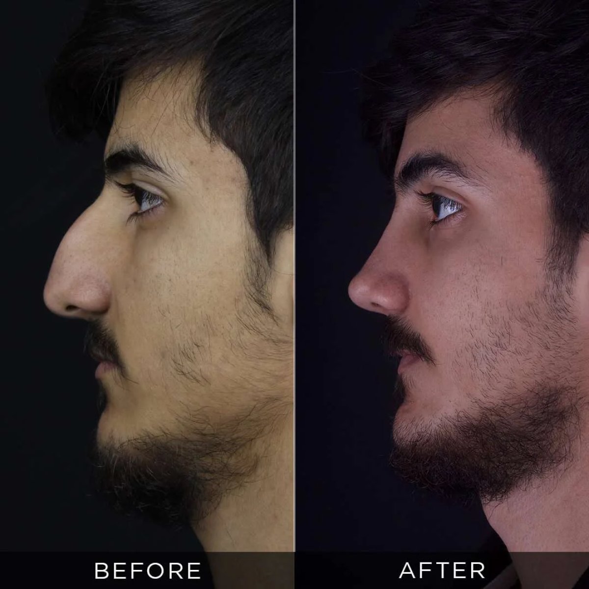 نتائج عملية تجميل الأنف قبل وبعد في عيادة د. حسن دويغولو، تحسين شكل الأنف