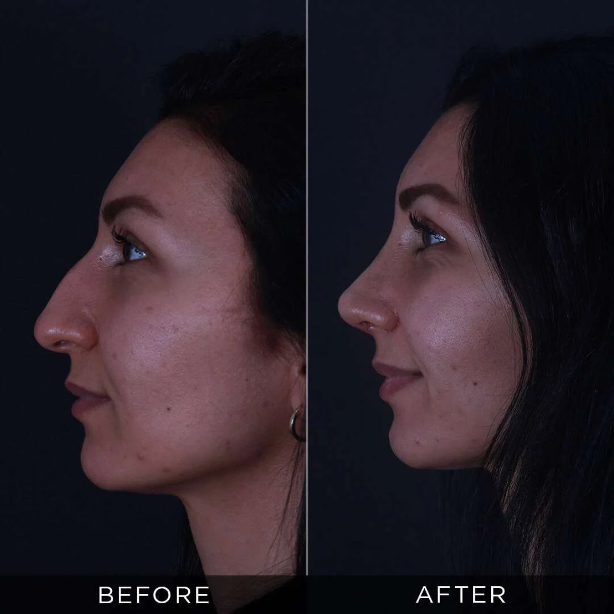 نتائج عملية تجميل الأنف قبل وبعد في عيادة Dr. Hasan Duygulu Private Practice، إعادة تشكيل الأنف