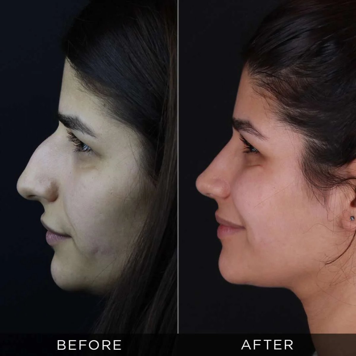 نتائج تجميل الأنف قبل وبعد في عيادة Dr. Hasan Duygulu Private Practice، إعادة تشكيل الأنف