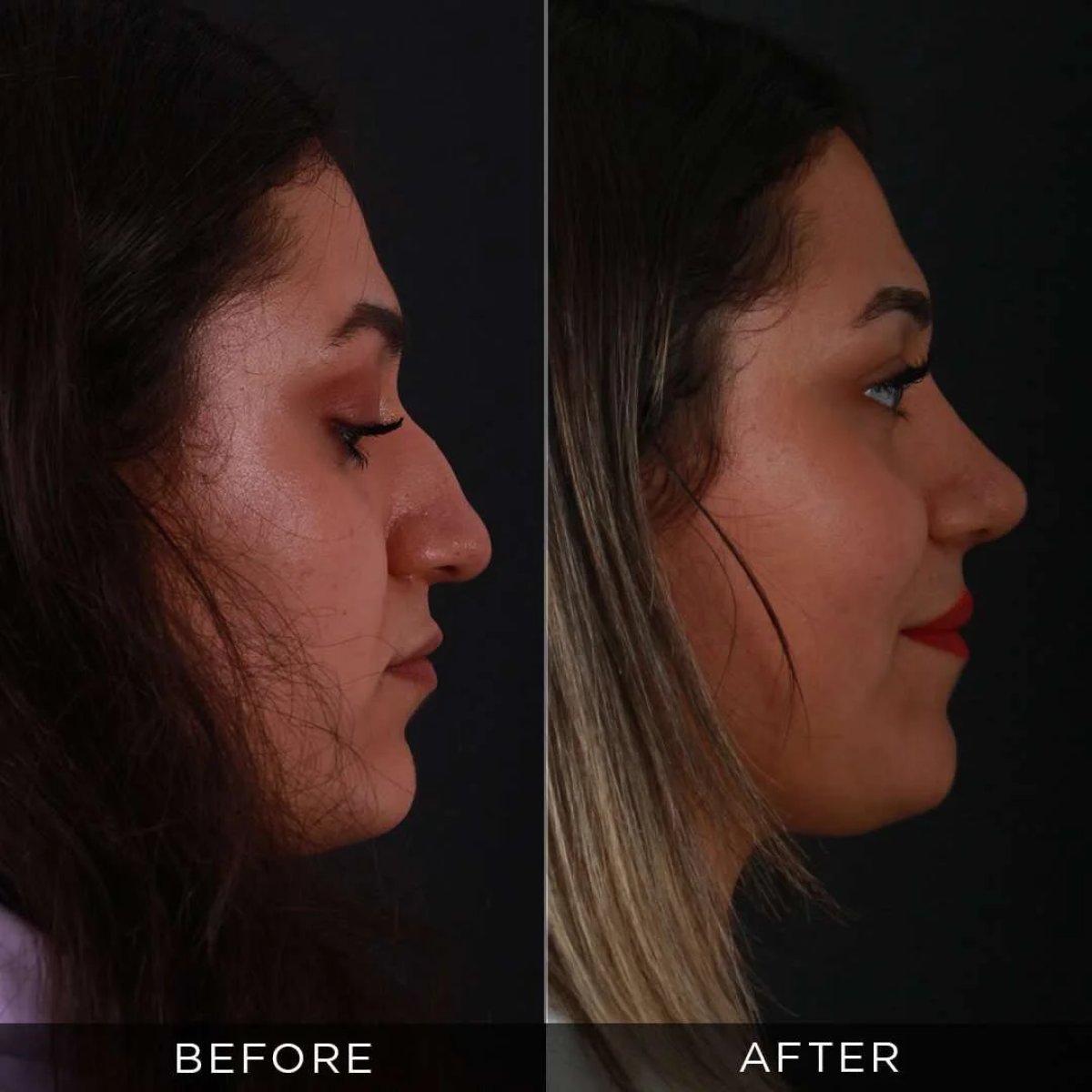 نتائج تجميل الأنف قبل وبعد في عيادة Dr. Hasan Duygulu Private Practice، إعادة تشكيل الأنف