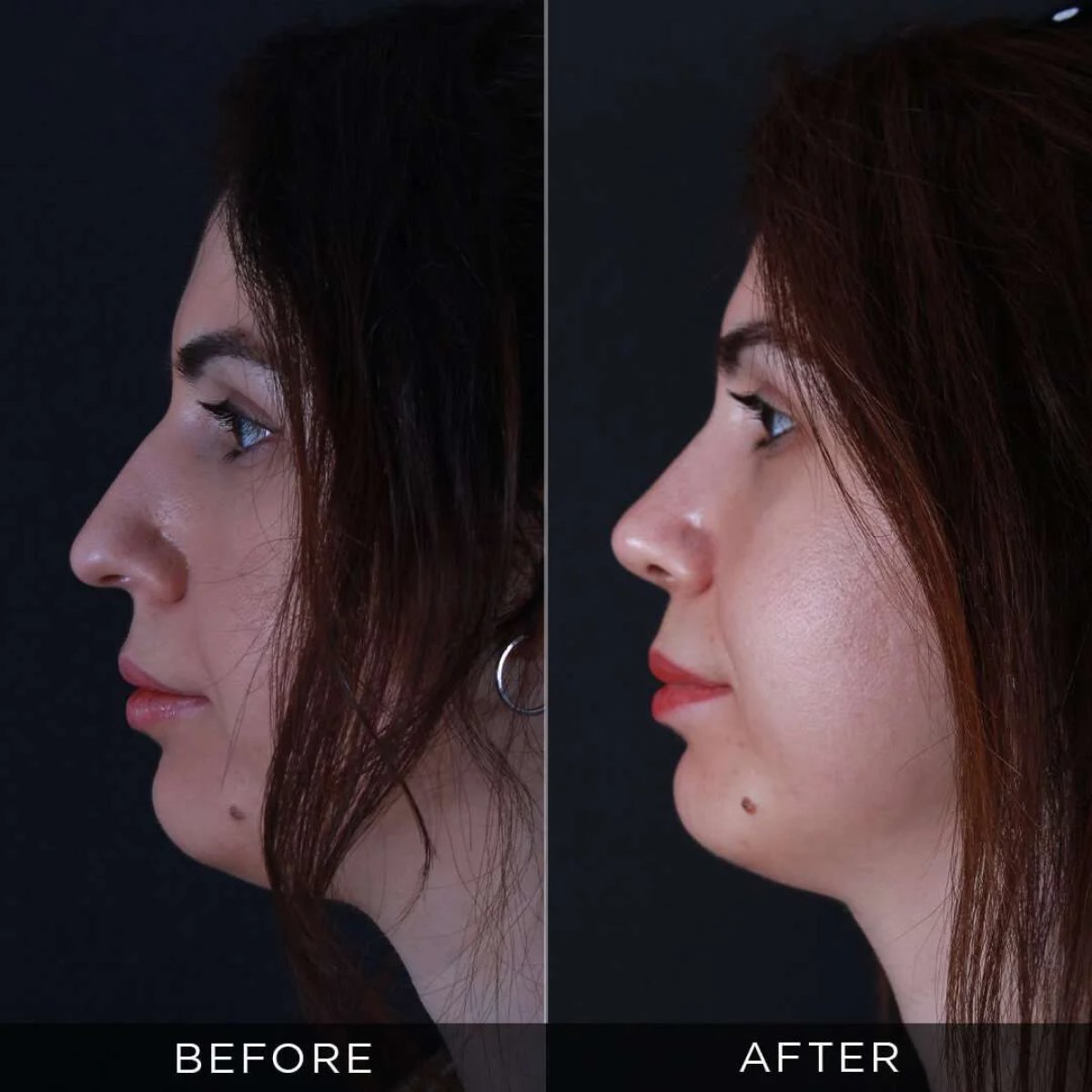 نتائج عملية تجميل الأنف قبل وبعد في عيادة Dr. Hasan Duygulu، تحسين شكل الأنف