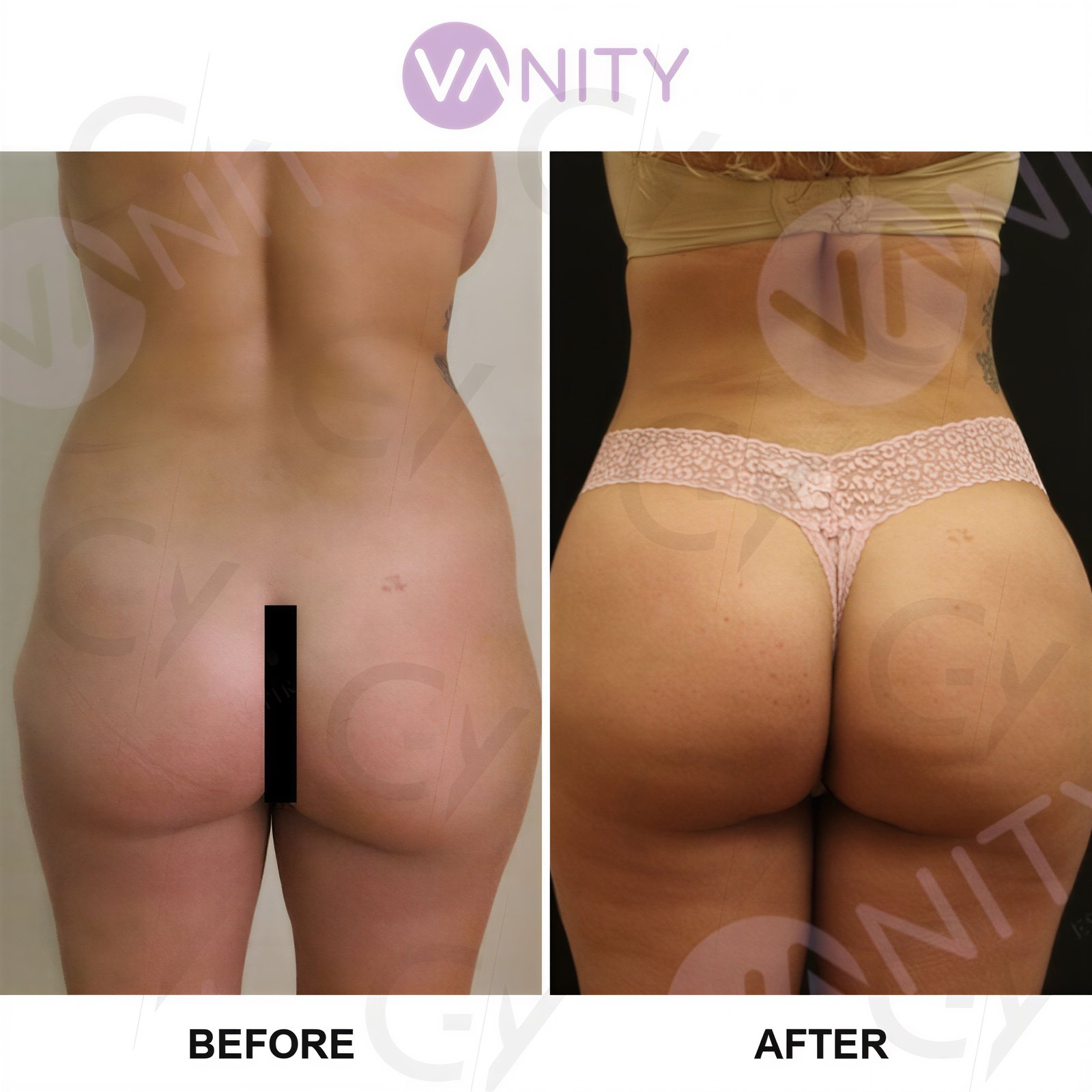 نتائج قبل وبعد عملية شد المؤخرة البرازيلية في Vanity Cosmetic Surgery Center