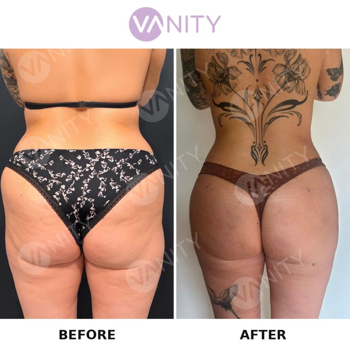 نتائج قبل وبعد عملية شد المؤخرة البرازيلية في Vanity Cosmetic Surgery Center