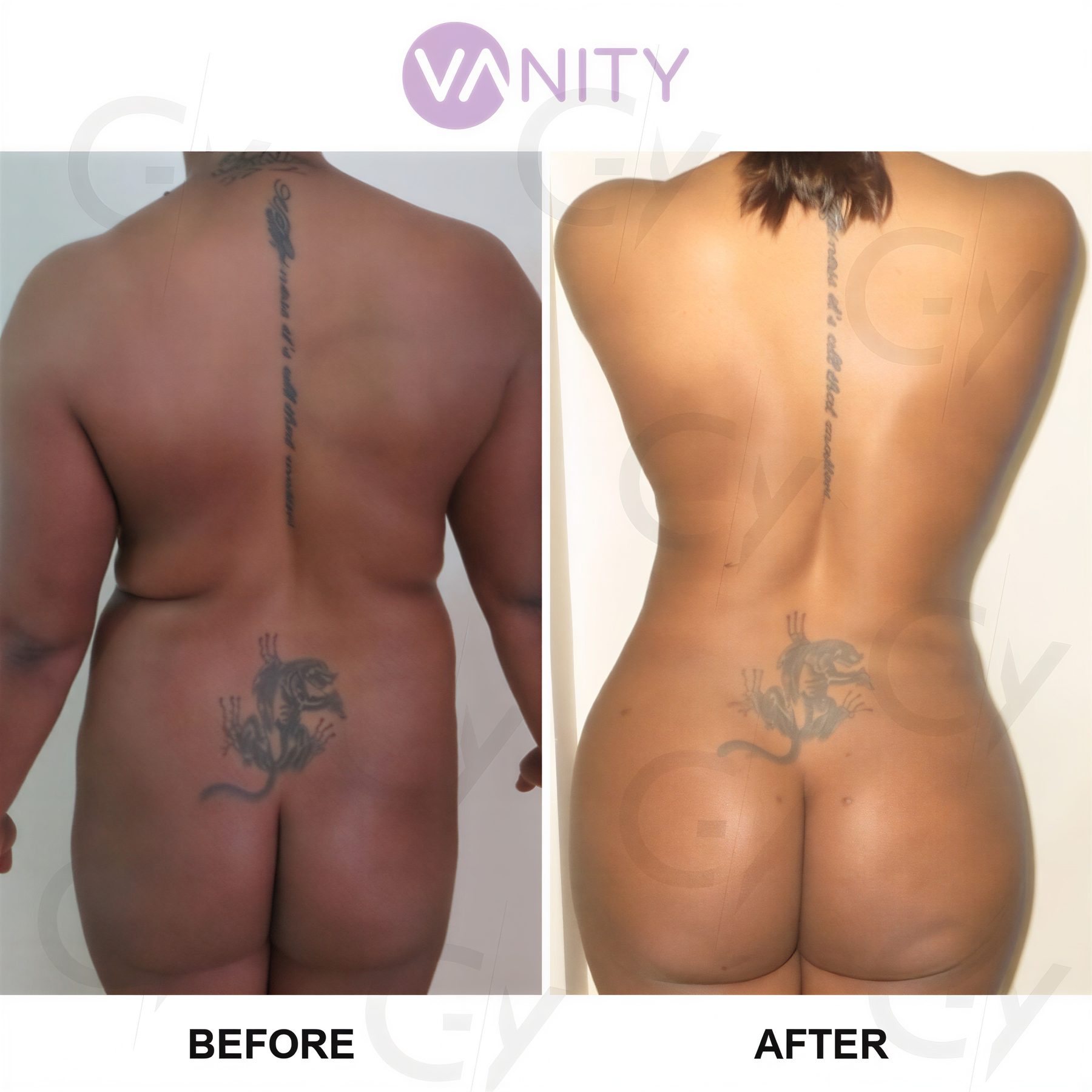 نتائج قبل وبعد عملية شد المؤخرة البرازيلية في Vanity Cosmetic Surgery Center، نحت الجسم