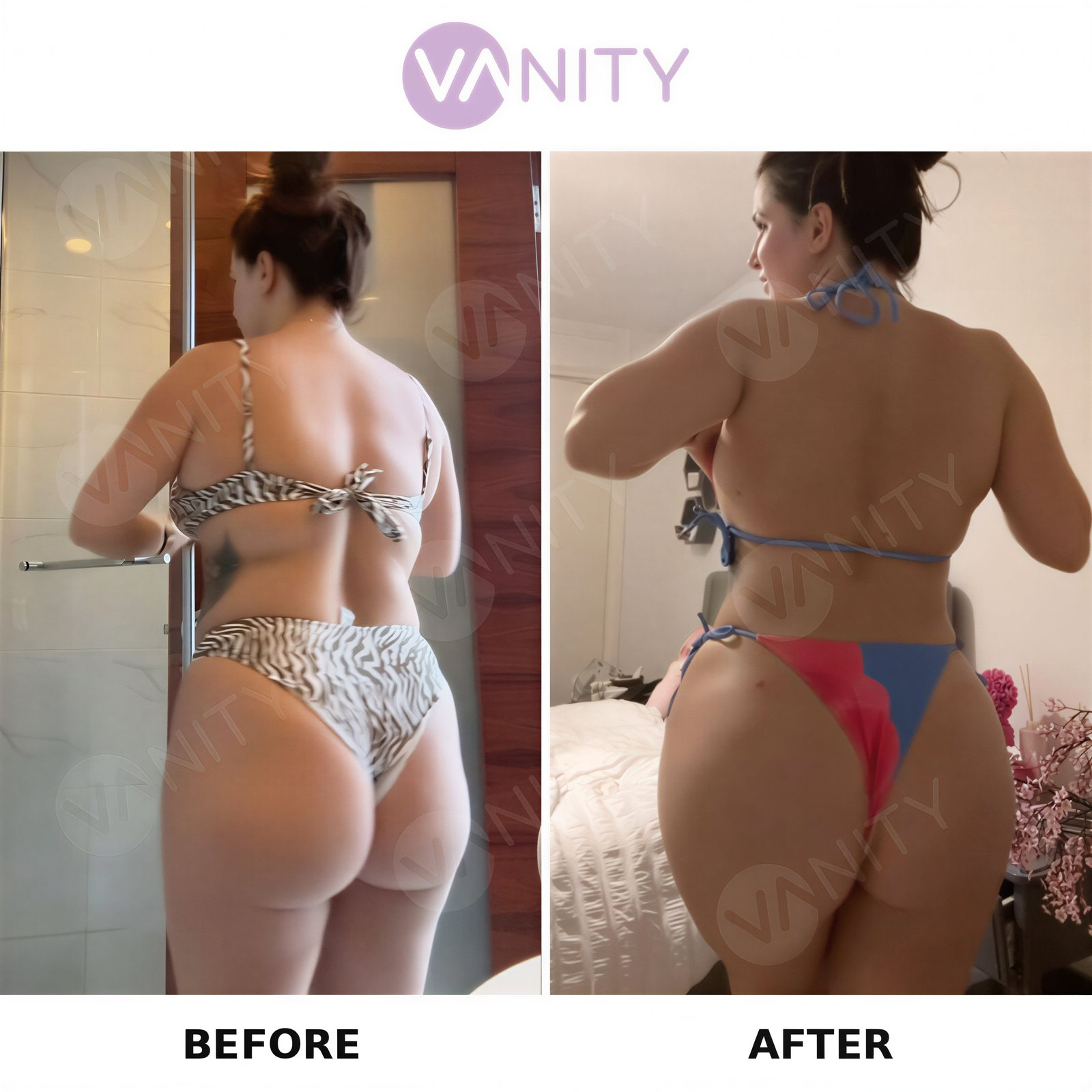 نتائج قبل وبعد عملية Brazilian Butt Lift في Vanity Cosmetic Surgery Center، منحنيات محسنة