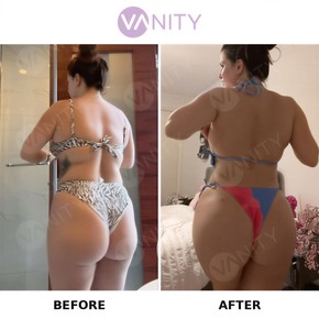 Standard Brazilian Butt Lift in Vanity Istanbul - photo 4