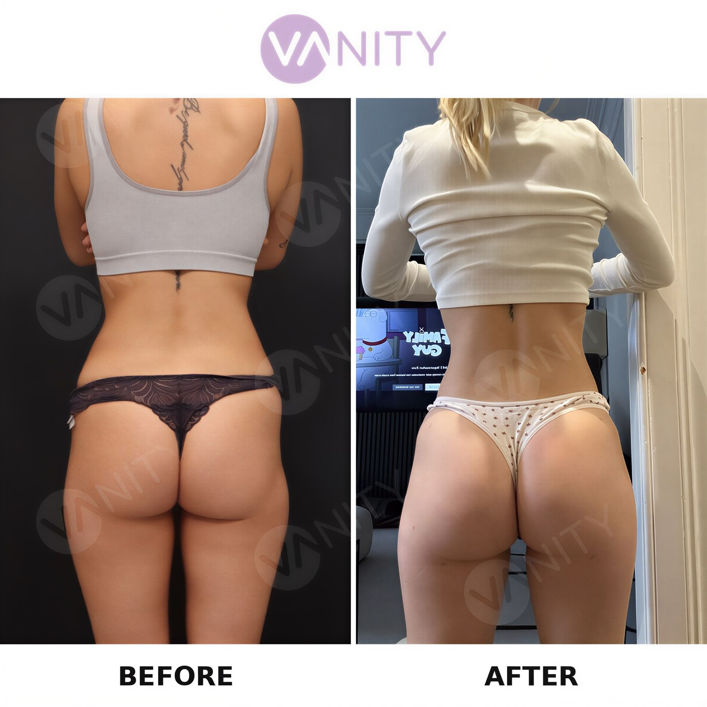 نتائج قبل وبعد عملية شد المؤخرة البرازيلية في Vanity Cosmetic Surgery Center