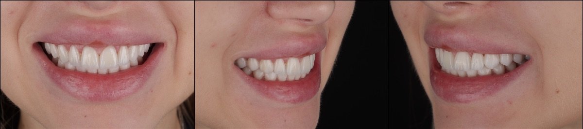 تحول الابتسامة بالفينير في عيادة RIKOTA Dental Clinic – نتائج طبيعية المظهر