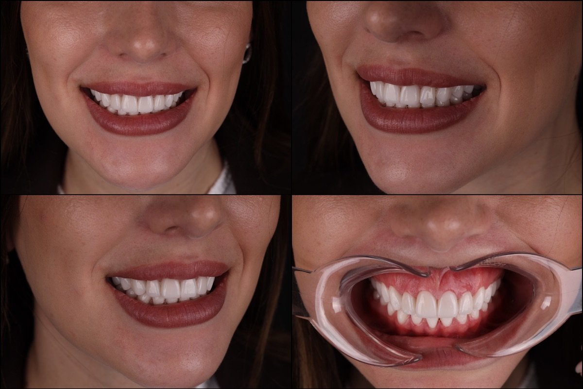 تحول الابتسامة مع قشور الأسنان في RIKOTA Dental Clinic، نتائج طبيعية المظهر