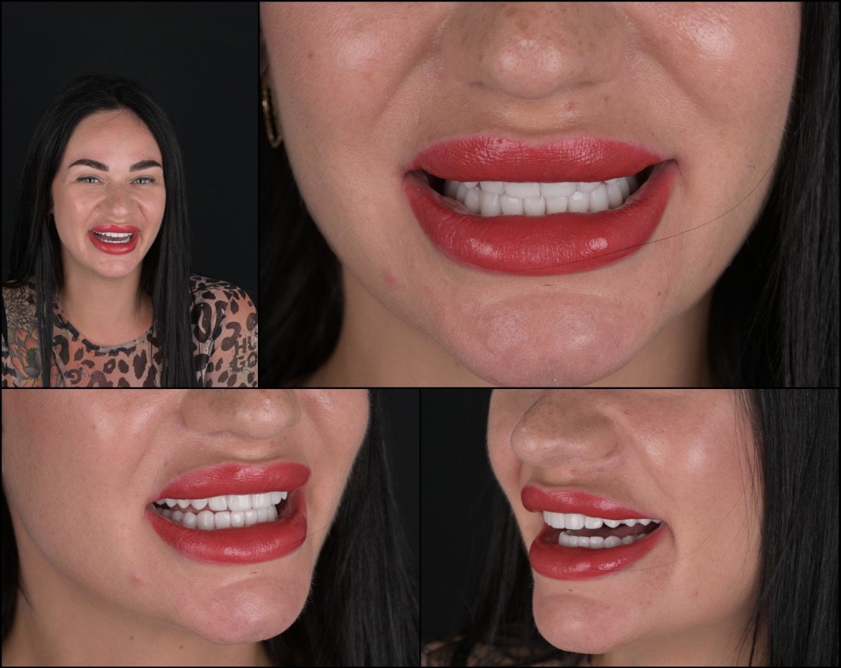 تحول الابتسامة بالفينير في عيادة RIKOTA Dental Clinic – نتيجة أسنان بيضاء طبيعية
