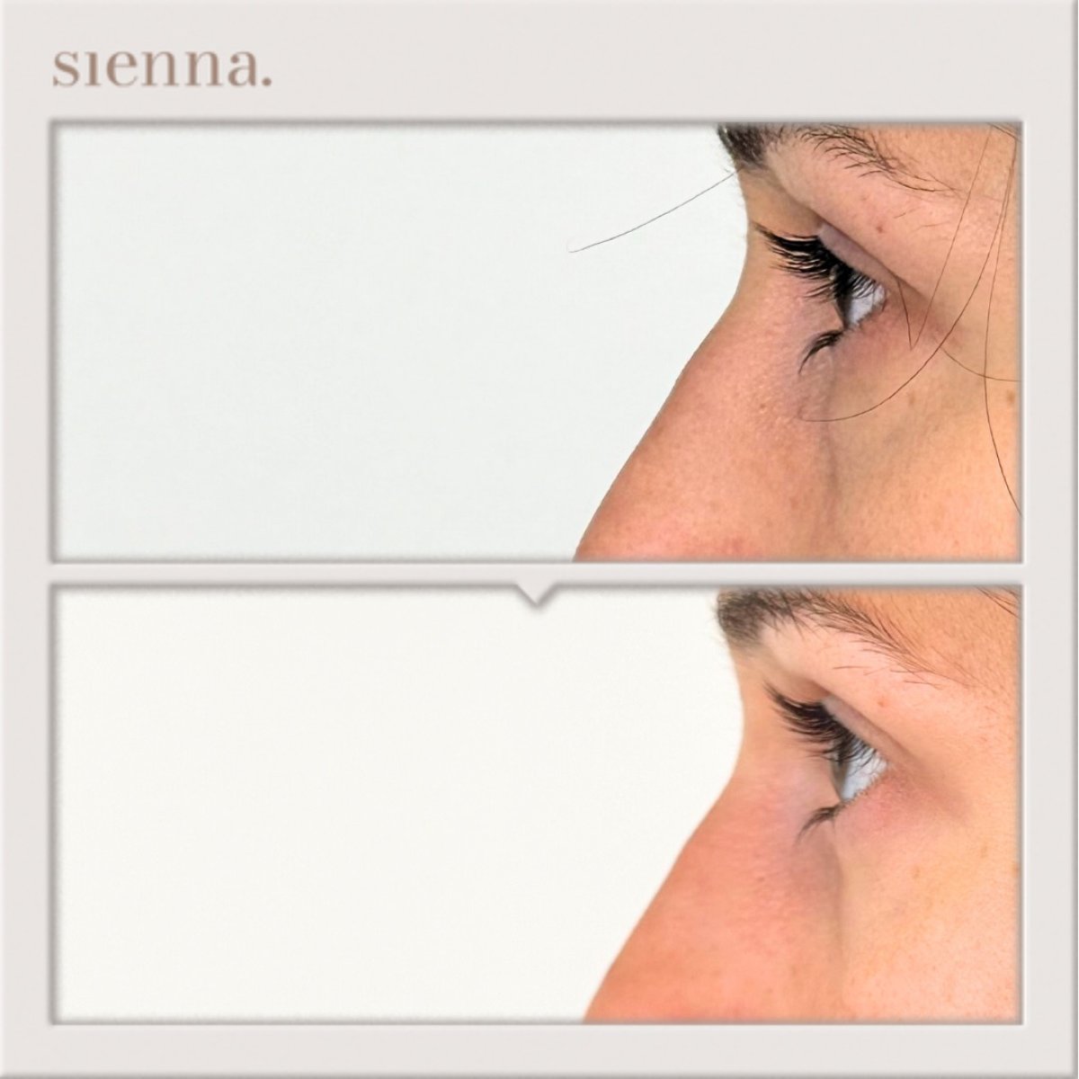 Résultats avant/après blépharoplastie des paupières inférieures à Sienna Clinic, rajeunissement du regard