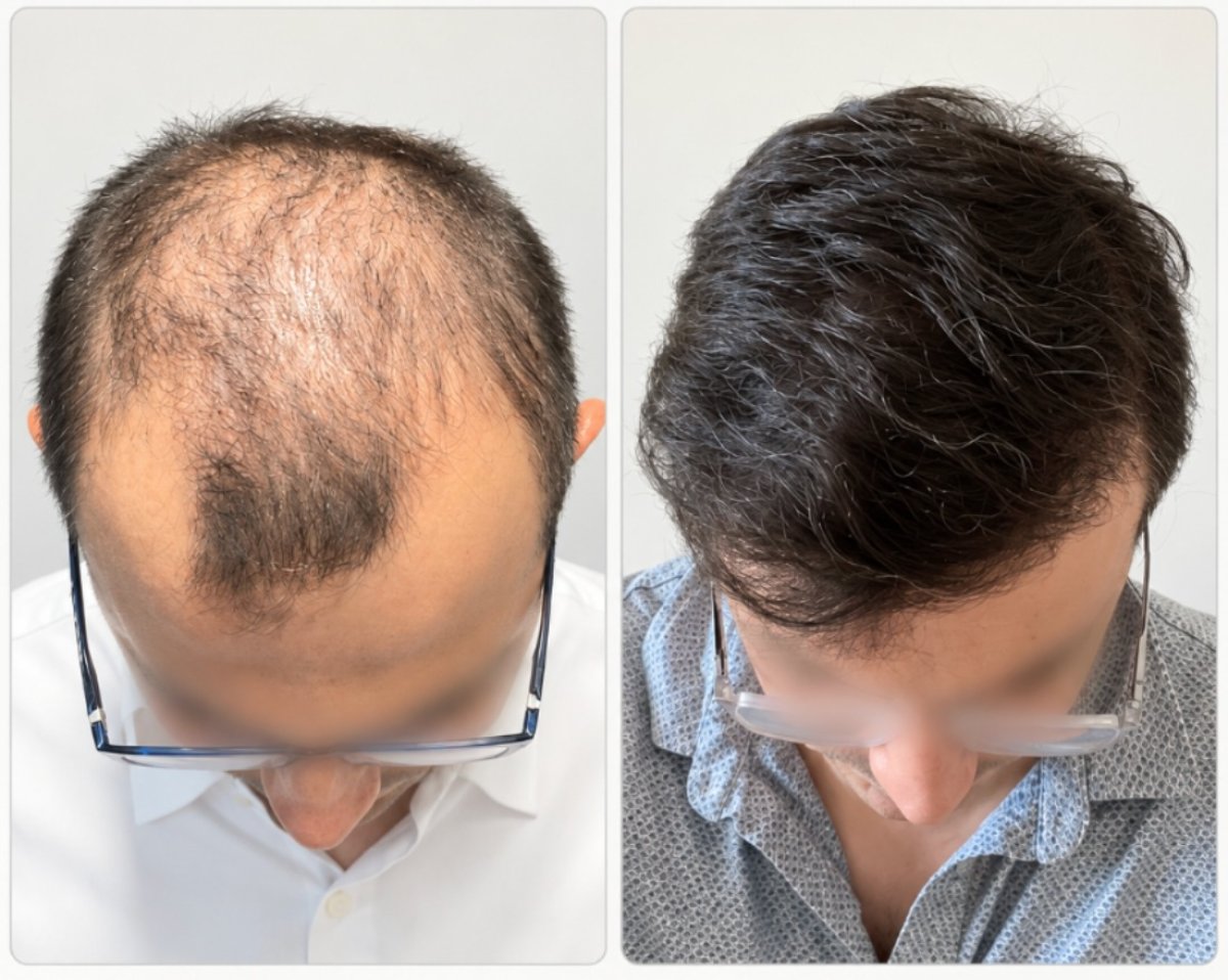 نتائج زراعة الشعر FUE قبل وبعد في مستشفى Hisar Hospital Intercontinental، استعادة خط الشعر