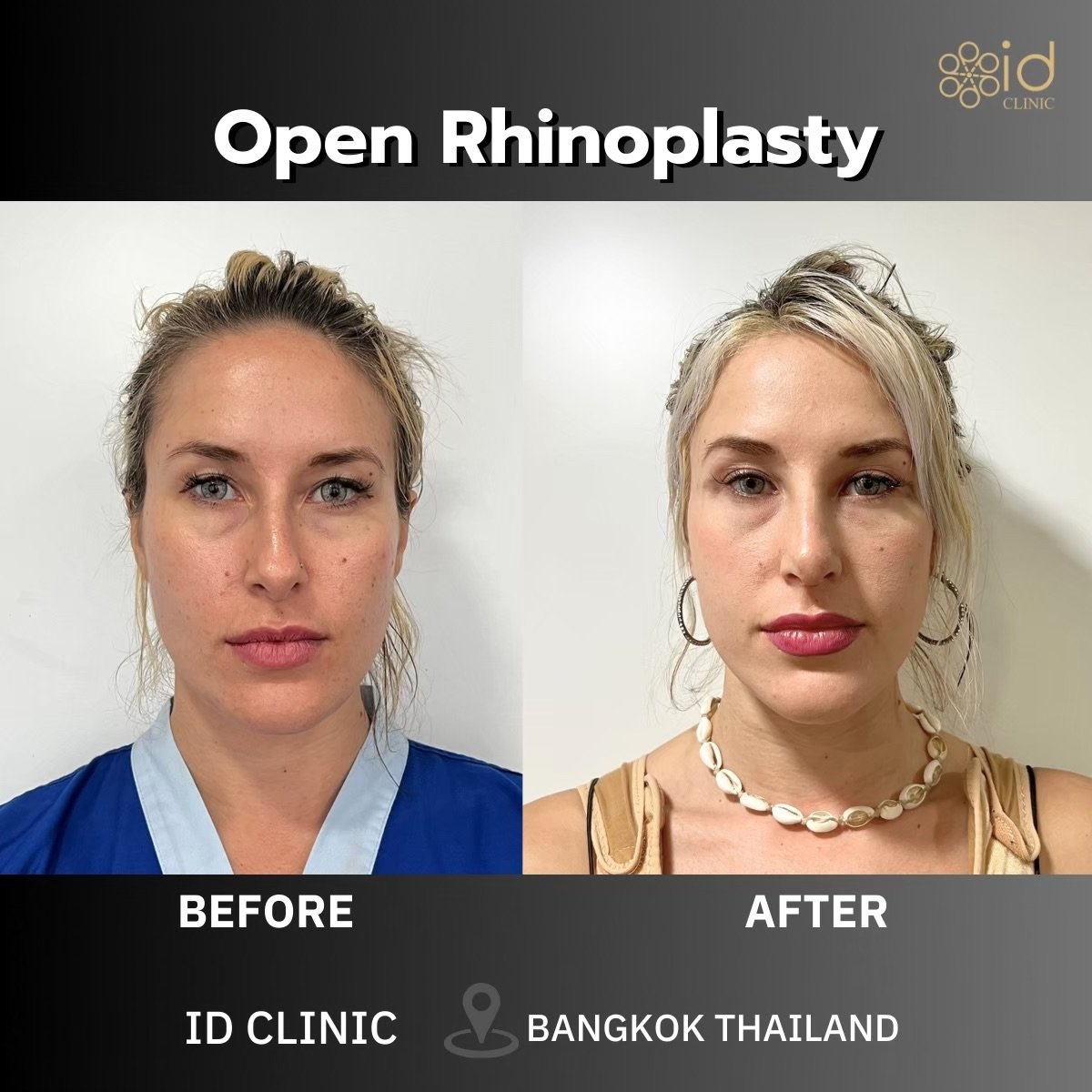 Resultados antes y después de rinoplastia abierta en ID Clinic Bangkok, remodelación nasal
