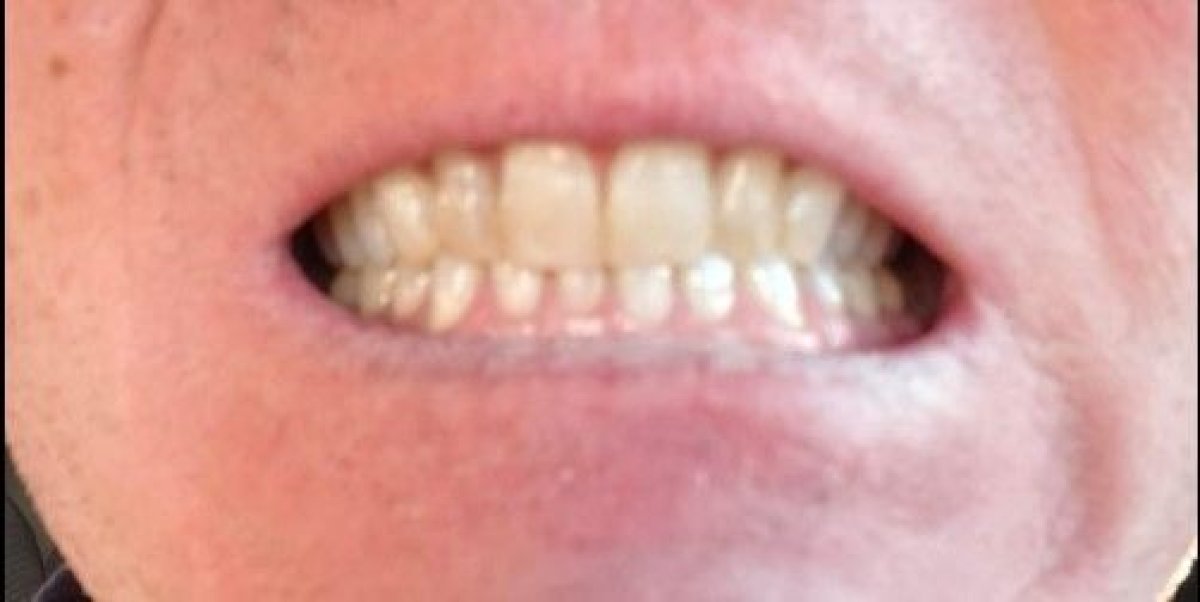 نتيجة تحول الابتسامة بعد قشور الأسنان في عيادة Smile Terminal Dental Care