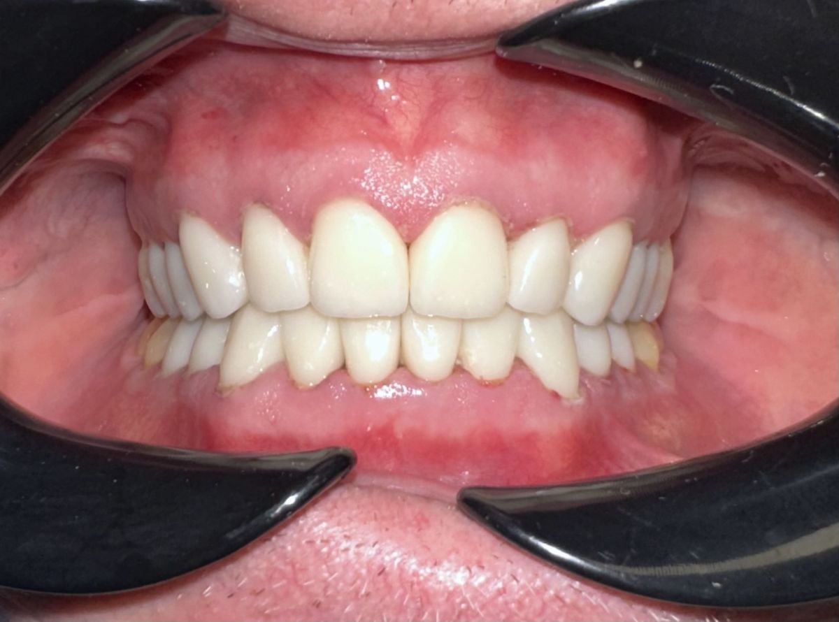 نتيجة الفينير في Smile Terminal Dental Care – تحسين جمالية واصطفاف الأسنان