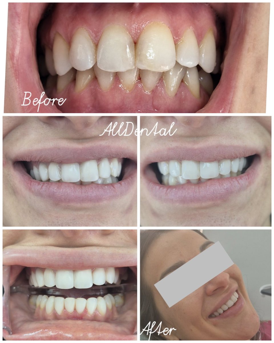 Resultados de antes y después de bonding dental en AllDental: sonrisa y alineación mejoradas